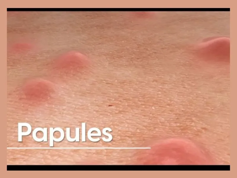 papules-min